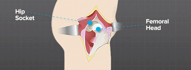 bone-and-hip-socket-preperation