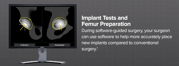implant-tests-and-femur-preparation