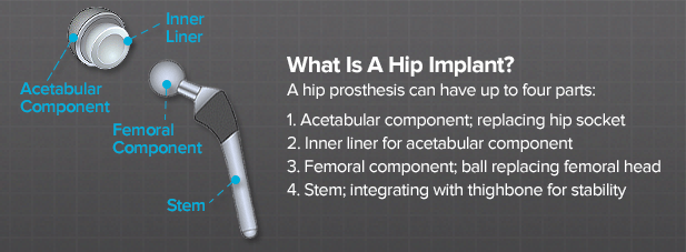 what-is-a-hip-implant
