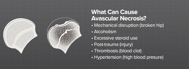 What is the typical treatment for avascular necrosis?