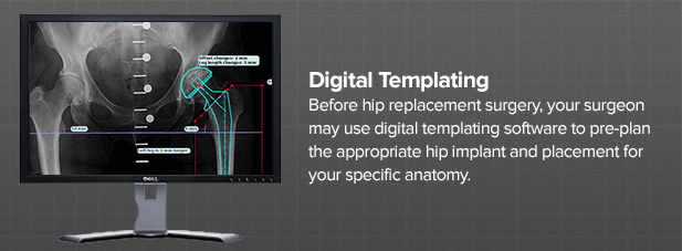 what-is-digital-templating