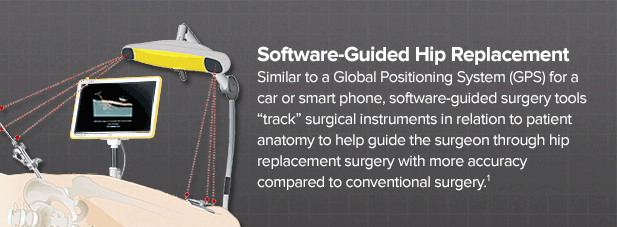 what-is-software-guided-hip-replacement