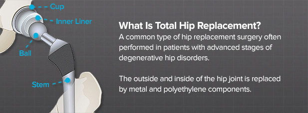 what-is-total-hip-replacement