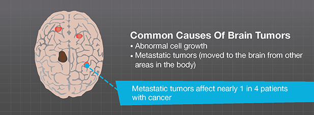 Brain tumors illustration