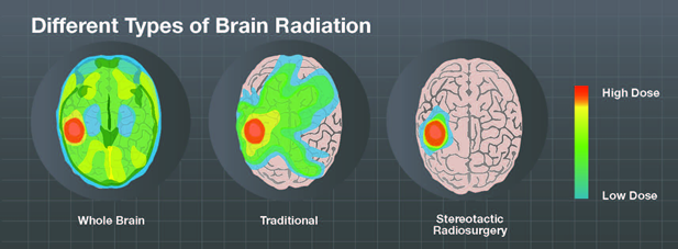 Different types of brain radiation