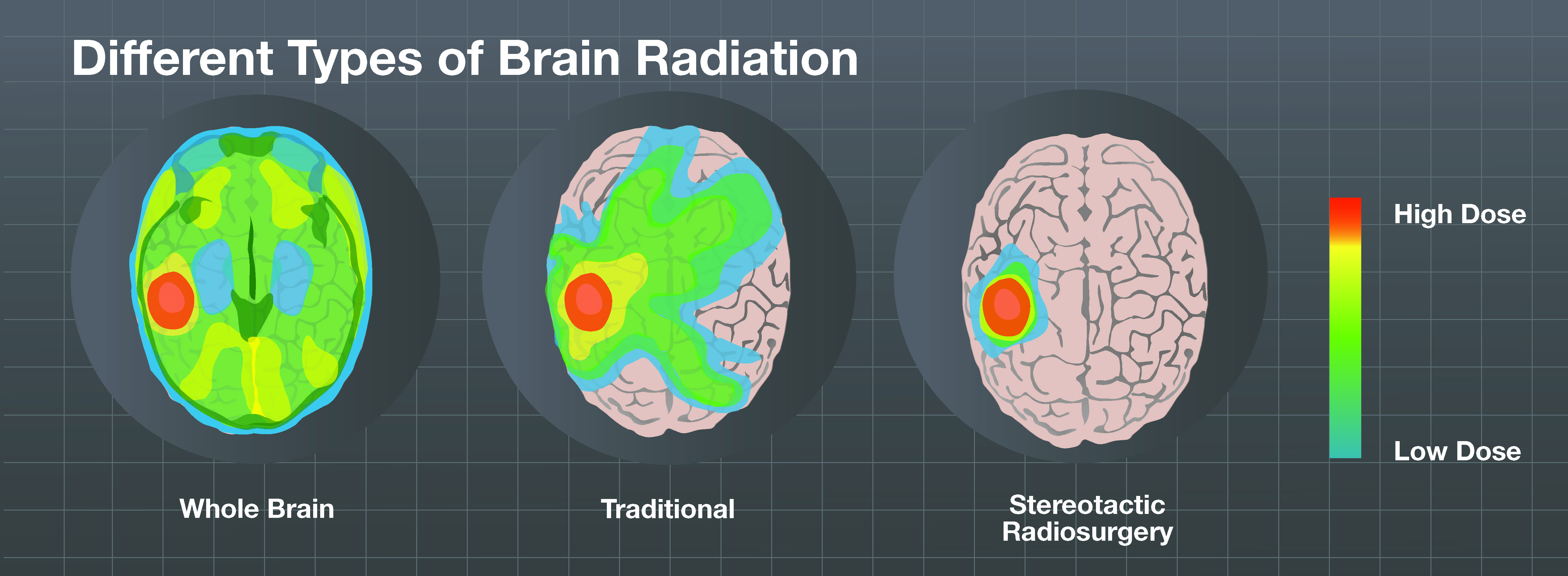 Types of Brain Radiation