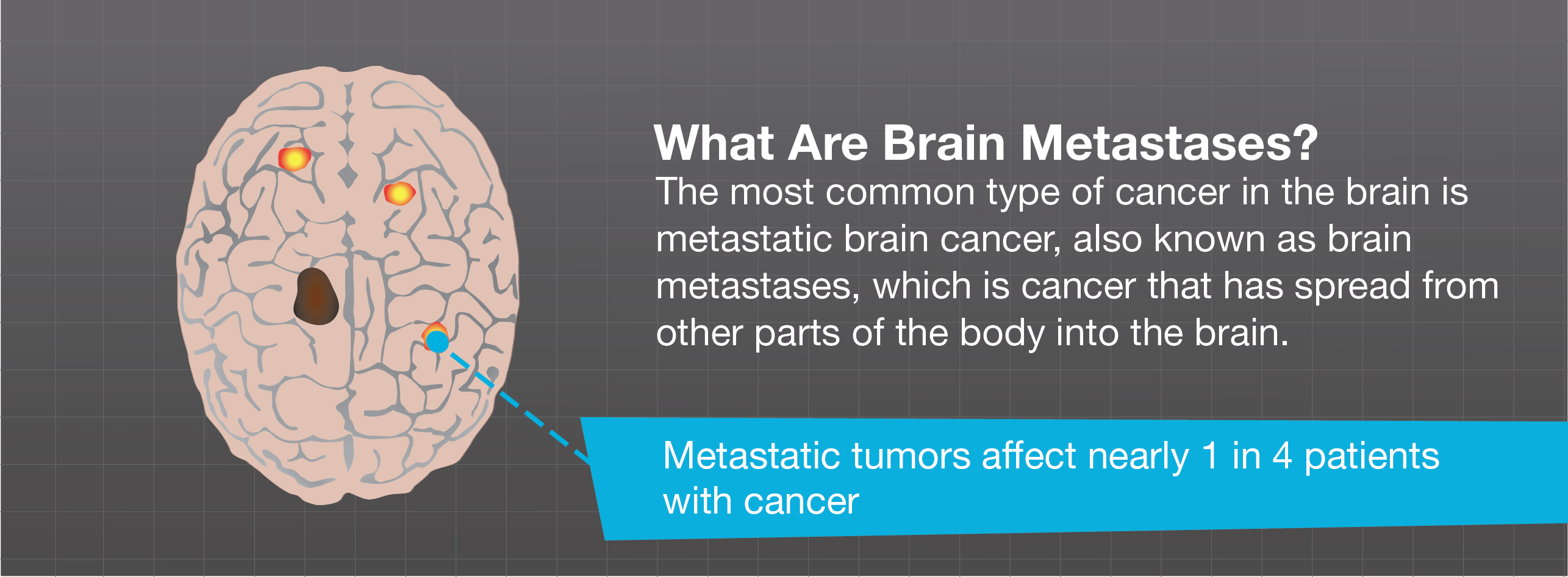 presentation for brain metastasis