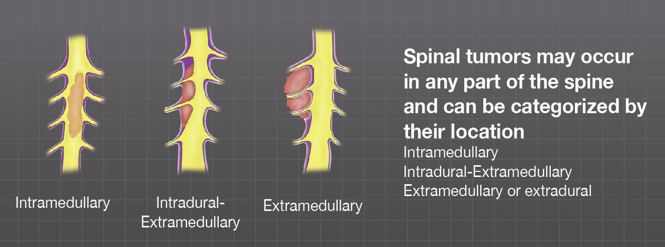 The three groups of the spine tumors