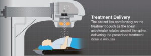 Delivery of spine radiation therapy with a linear accelerator (linac) for the treatment of spine cancer